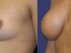 5b-breast-enlargement
